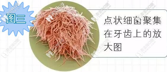 牙齒放大后上面的點(diǎn)狀細(xì)菌