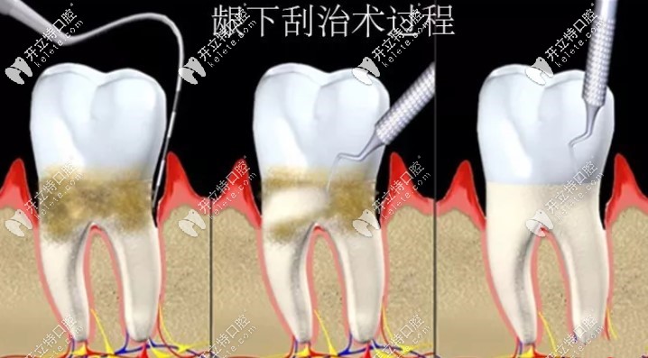 為啥有人說(shuō)齦下刮治后悔死了,難道是因?yàn)橛猩陡弊饔脝幔? border=