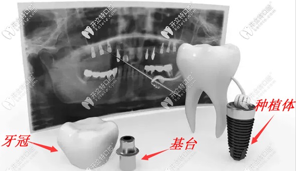 關(guān)于種植牙中復(fù)合基臺(tái)和普通基臺(tái)的區(qū)別,不懂的看這里