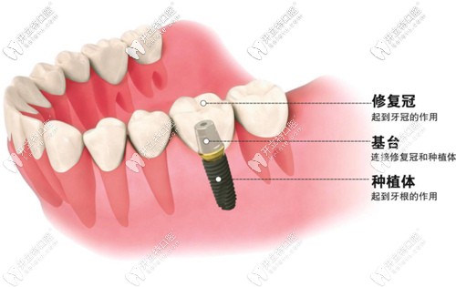 別迷糊,種植牙的原裝成品基臺(tái)和個(gè)性化定制基臺(tái)區(qū)別在這