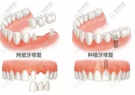 都知道進(jìn)口種植牙價(jià)格有些貴,但這家的費(fèi)用比全瓷牙還劃算