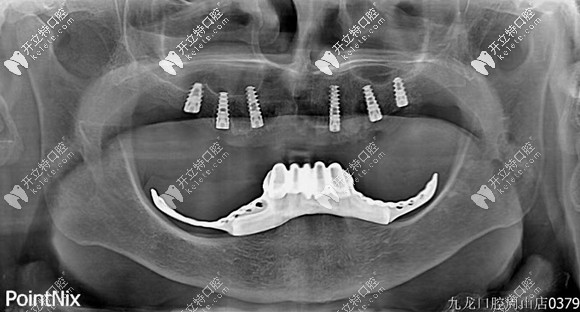 看好了:這是用美國百康種植體做的all-on-6半口種植牙案例哈