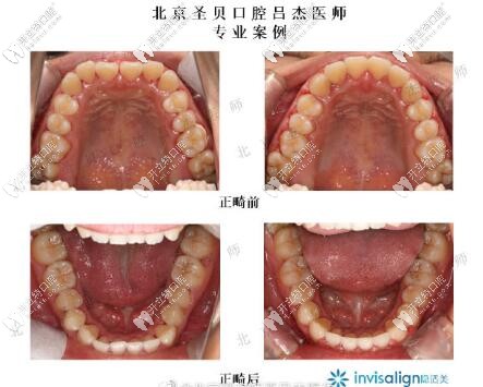 北京圣貝齒科呂杰隱形正畸案例前后對比