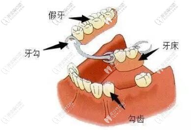 活動假牙圖示