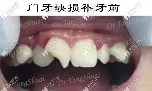 兒子門牙缺損一個角,用意大利美塑樹脂補(bǔ)的牙還挺耐磨