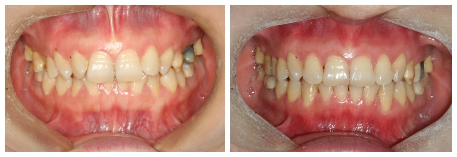 隱形牙套矯正深覆合沒效果?她做時(shí)代天使不到2年告別了嘴凸