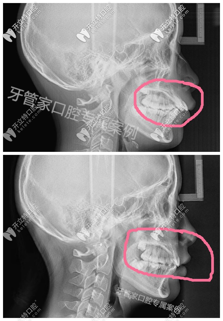 我骨性和牙性齙牙內(nèi)收6mm側(cè)面x光效果圖