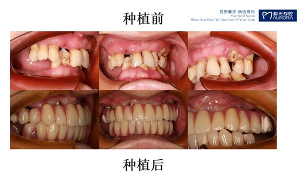 成都極光口腔避免做全口種植牙后悔,來(lái)一波全口牙缺失種植案例供你參考
