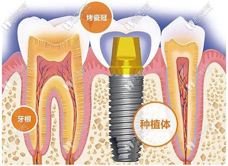 為什么種植牙價(jià)格相差那么大，區(qū)別究竟在哪里？