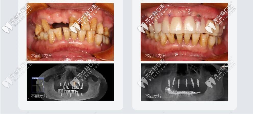 All-on-6種植牙前后照