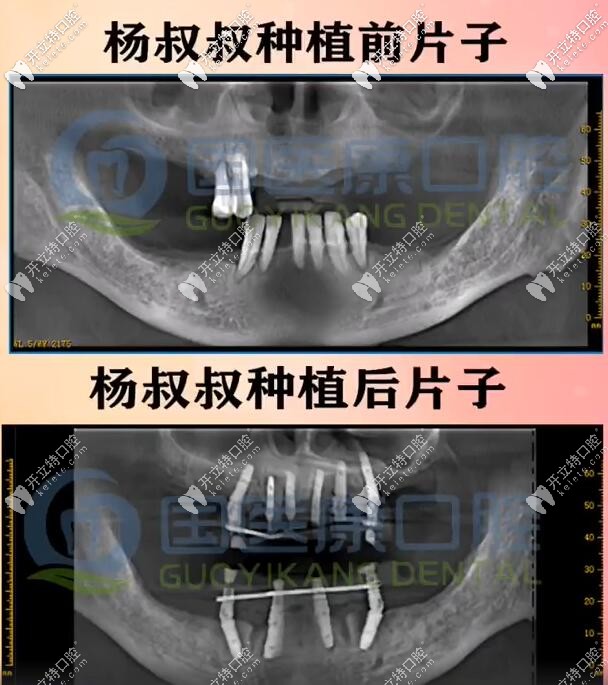 71歲楊叔做一日得全口種植牙種了10顆植體，上半口6下半口4