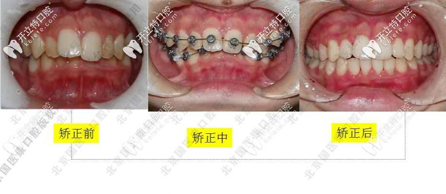 孩子深覆合加深覆蓋挺好矯正的,選的是OBrace球面自鎖托槽