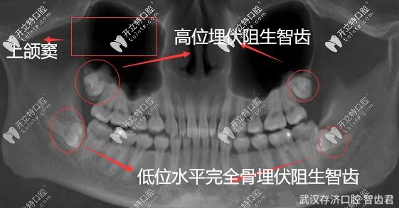 武漢拔牙案例|超聲骨刀微創(chuàng)拔除埋伏阻生智齒,詳解過程圖解