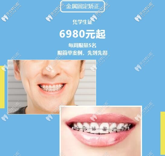 暑期學(xué)生做金屬托槽矯正多少錢呢?憑學(xué)生證享鋼牙套6980元啦