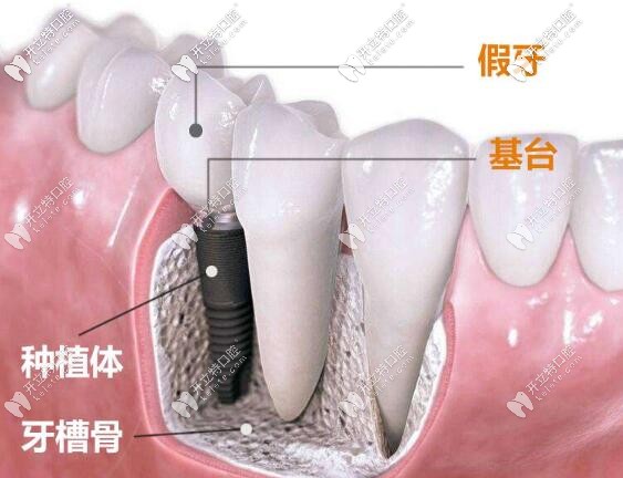 種植牙結(jié)構(gòu)圖