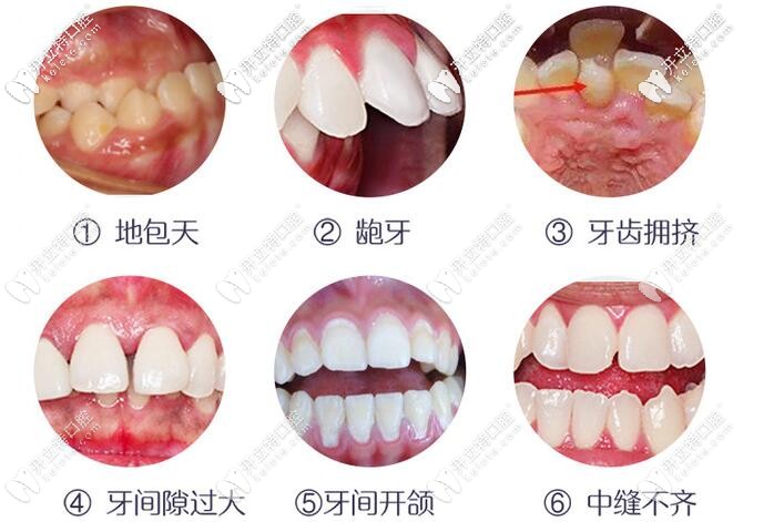 牙齒不齊的危害