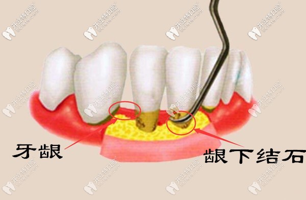 為什么牙結(jié)石會(huì)長(zhǎng)到牙齦里面？齦下牙結(jié)石怎么處理？