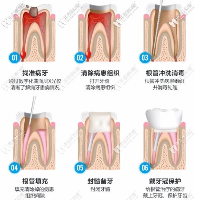 顯微鏡根管治療術(shù)過程的步驟