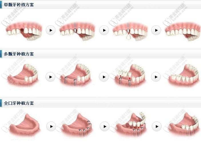 登騰種植體適合各種缺牙問題