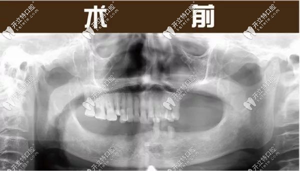 親述:在杭州美奧口腔學院路店種4顆半口種植牙的感受