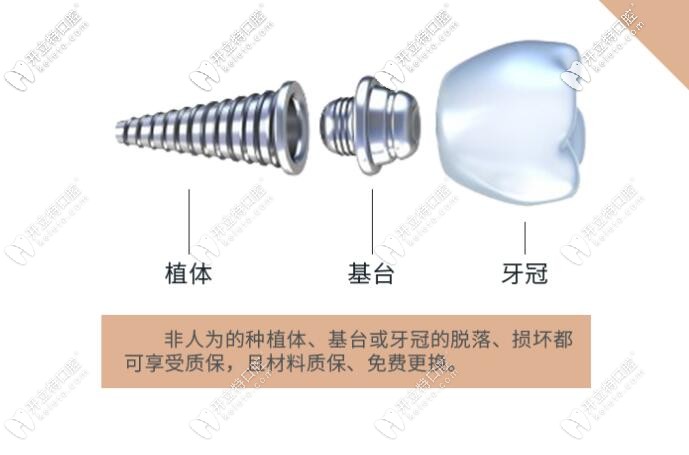 鈦植口腔種植牙終生質(zhì)保條款