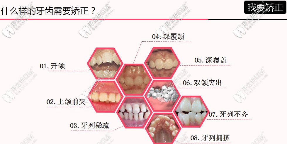 牙齒矯正適應癥