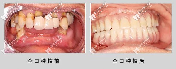 69歲退伍老兵做了ALL- on-6全口種植牙，感言：再活30年！