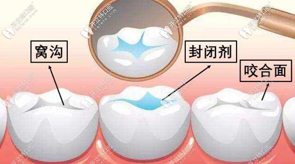 北京圣貝海淀牙科解鎖兒童六齡齒窩溝封閉有必要做嗎？