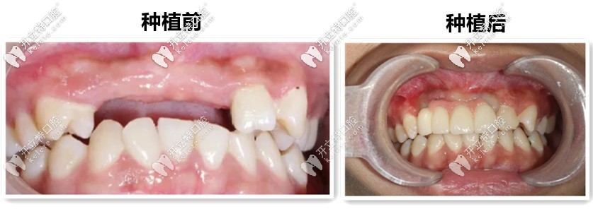 19歲妞門牙缺失4個,來吐槽“鄭州唯美口腔”的種植牙技術(shù)