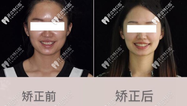 記錄我牙齒內(nèi)傾使用進(jìn)口隱適美牙套矯正兩年的過程 