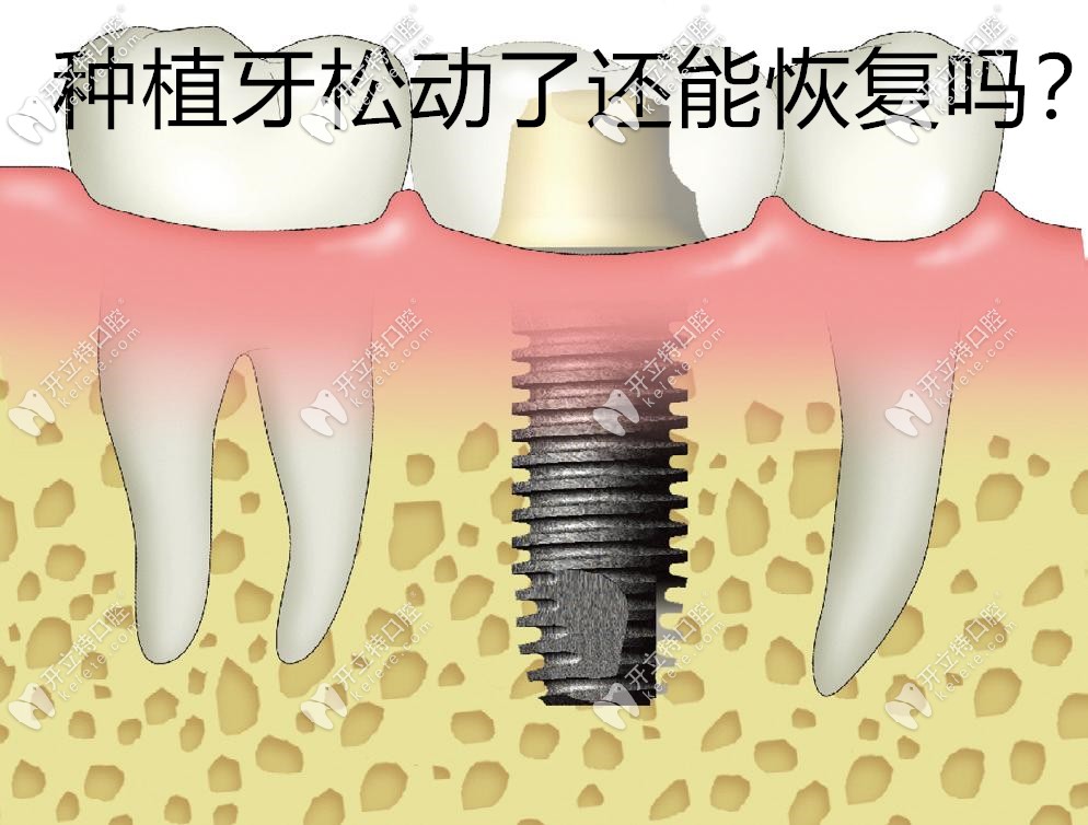 種植牙幾年后松動(dòng)了還能恢復(fù)嗎?如果種植牙失敗費(fèi)用誰(shuí)承擔(dān)