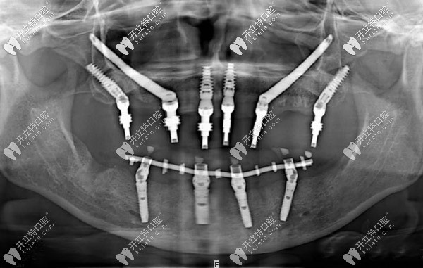 上海鼎植口腔做種植牙怎么樣,已為多位高齡老人裝了滿口牙