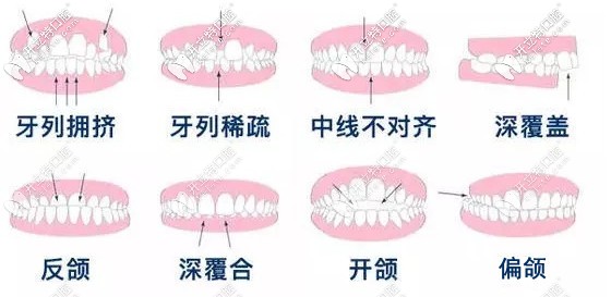  渭南牙科做牙齒矯正多少錢？想知道隱形和金屬矯正的價格