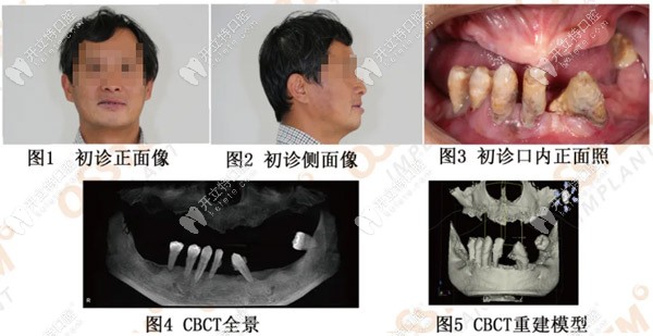 在先鋒鉆導(dǎo)板的輔助下,全口即刻負(fù)重咬合重建的病例完成了