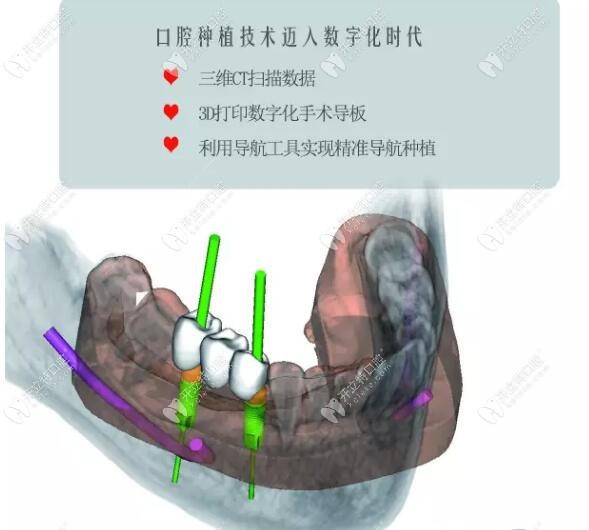 3d導(dǎo)板種植牙