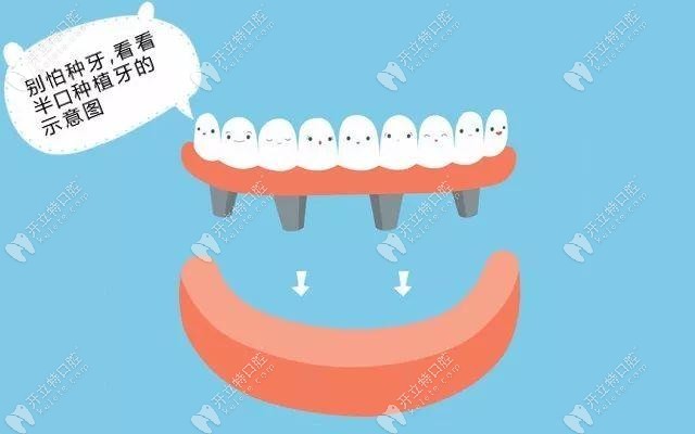 武漢德韓口腔種植牙活動