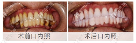 即刻種植牙手術(shù)前后對比